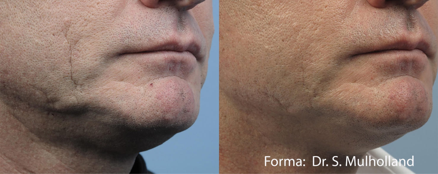 What Is Forma Skin Tightening? Its Benefits And How It Works